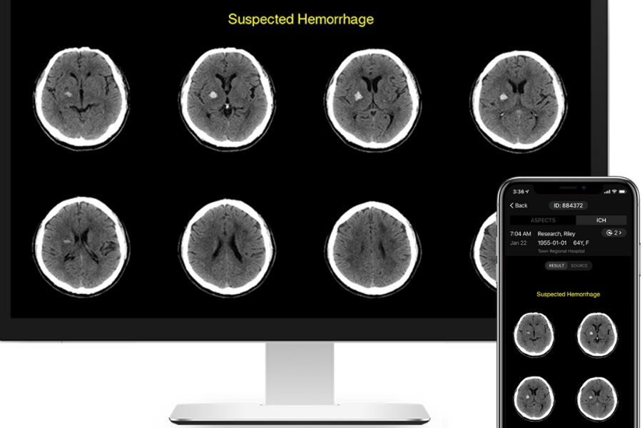 RapidAI NeuroImaging Stroke Software